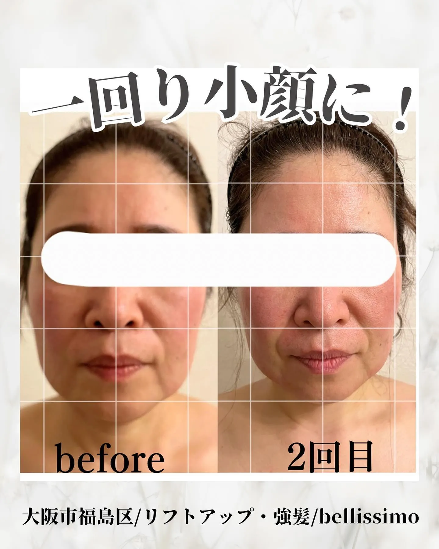 大阪市福島区で小顔になりヒト幹細胞培養液で肌ツヤ効果も発揮✨