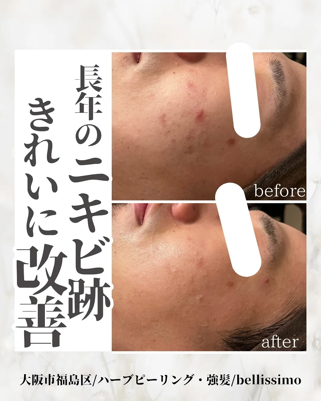 医療よりも早い？！ハーブピーリングで赤みニキビ跡も改善❤️‍...