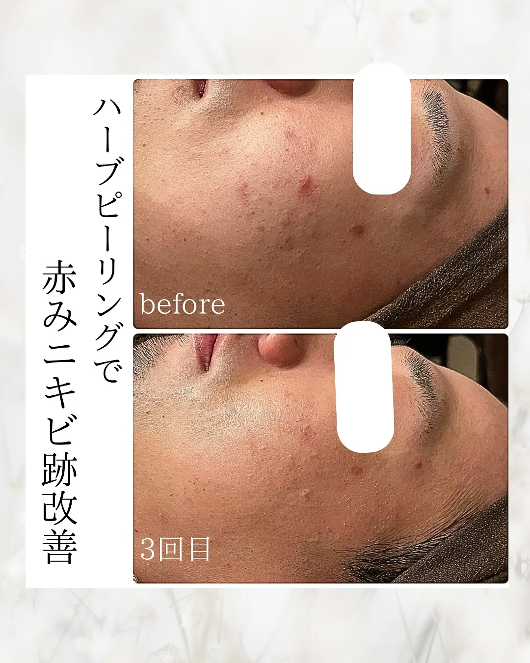 医療よりも早い？！ハーブピーリングで赤みニキビ跡も改善❤️‍...