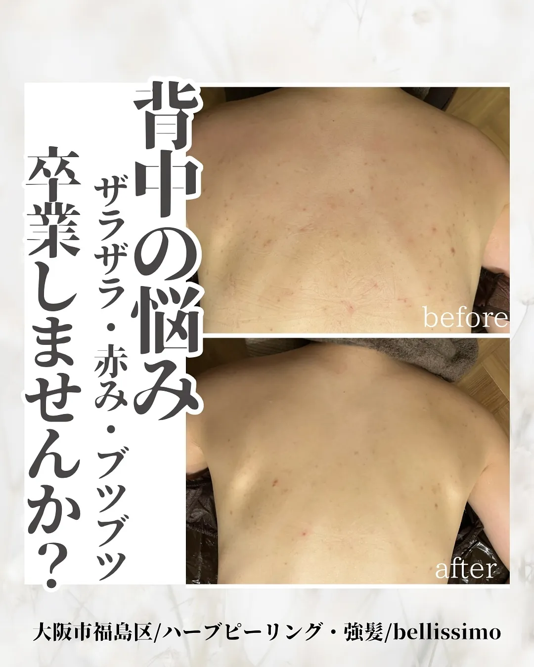 【ブライダル前にも必見】赤み、ブツブツ、ザラザラの背中ニキビ...