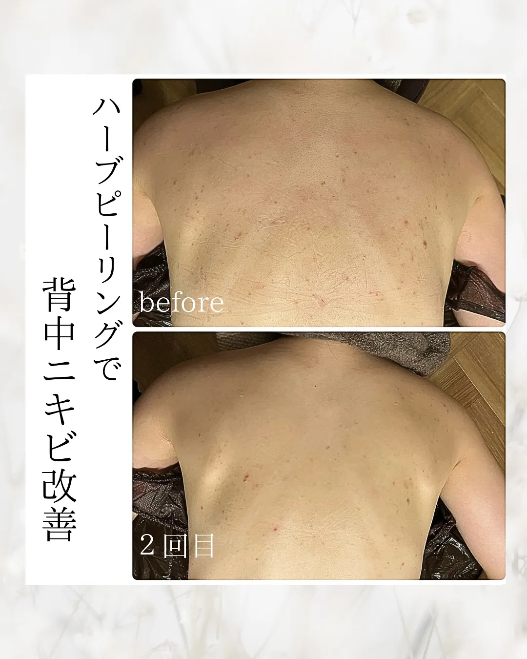 【ブライダル前にも必見】赤み、ブツブツ、ザラザラの背中ニキビ...