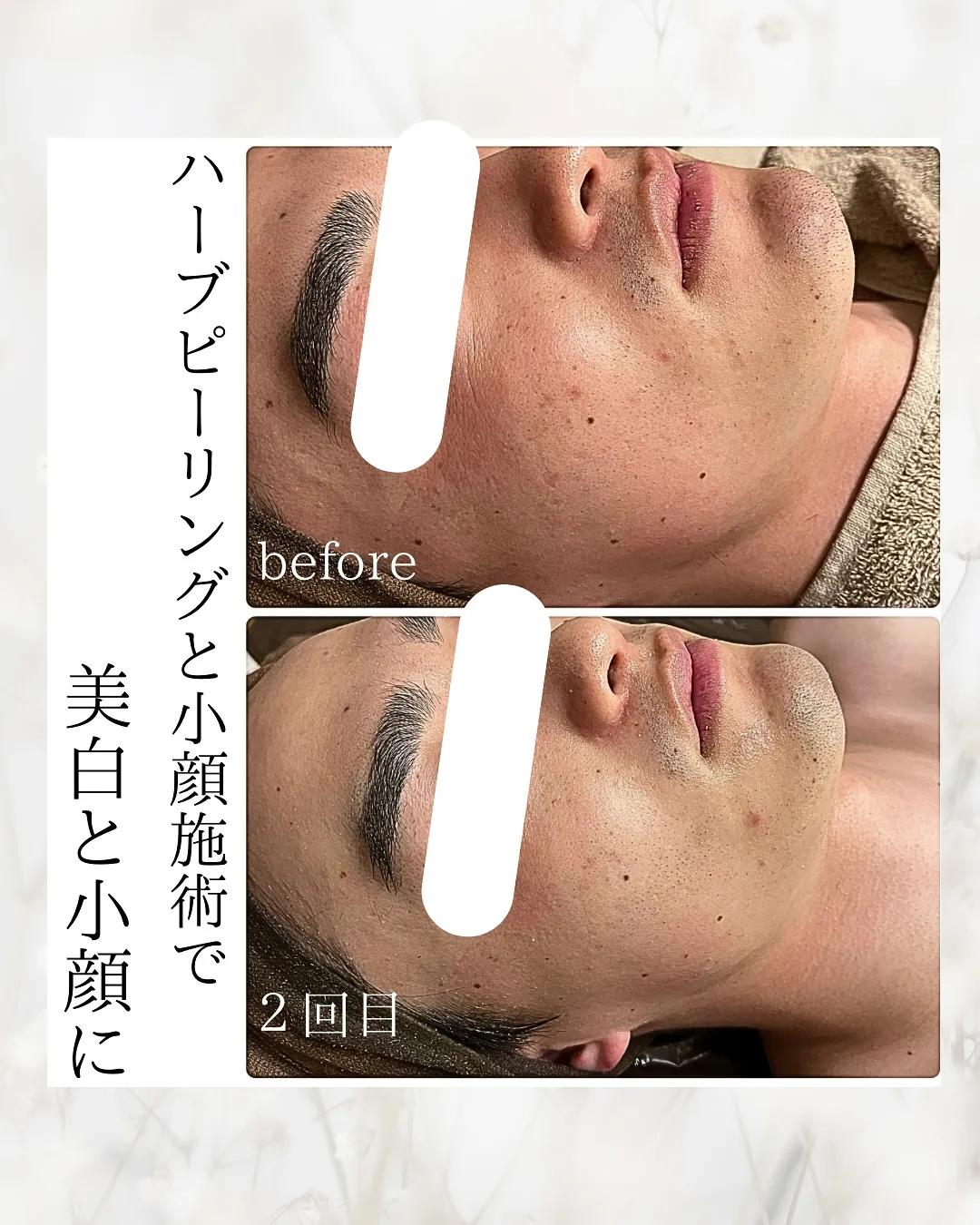 男性も美肌ケアでハーブピーリングしている方増えています！🌿