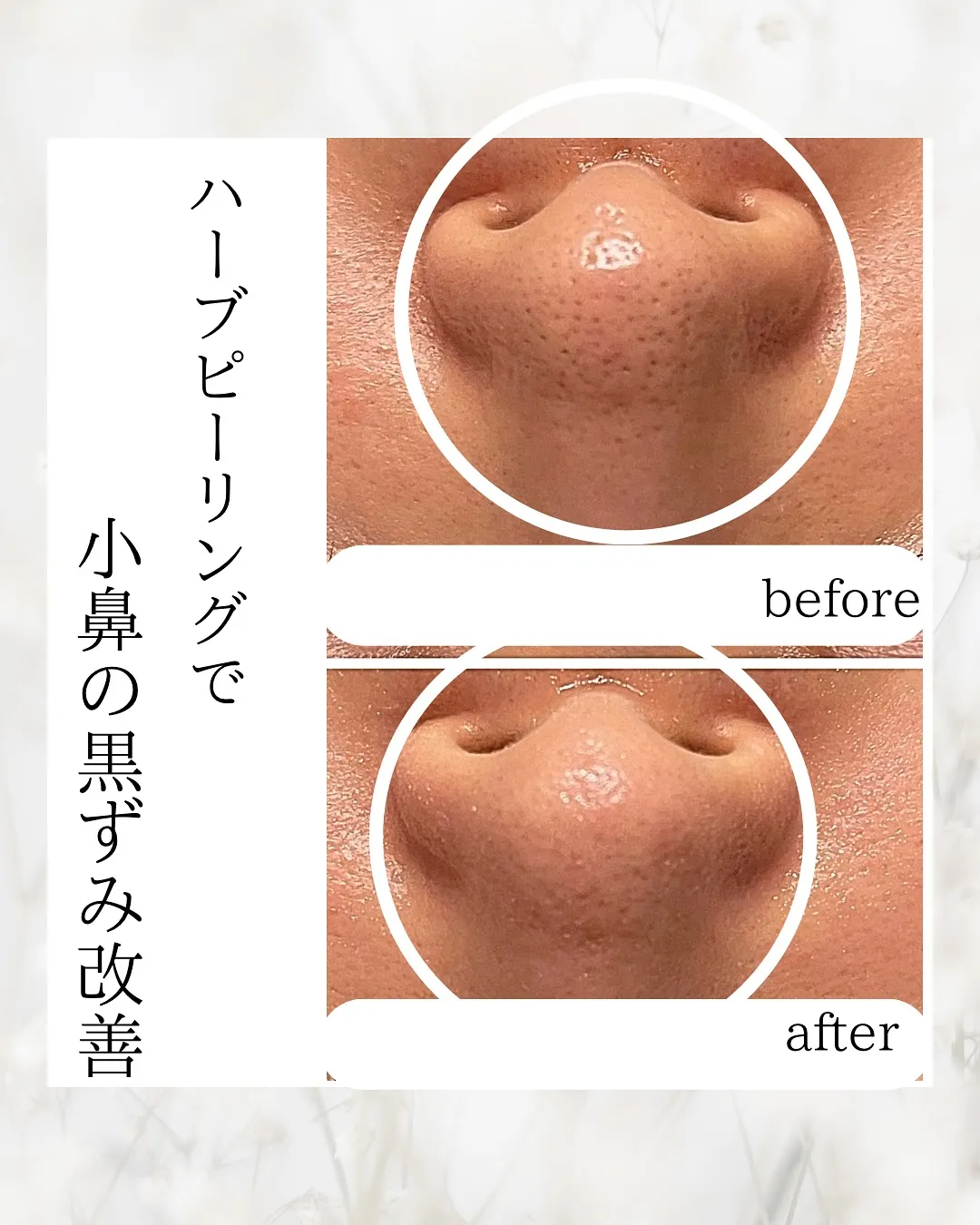 これからの季節気になる鼻の黒ずみ改善ハーブピーリング🌿