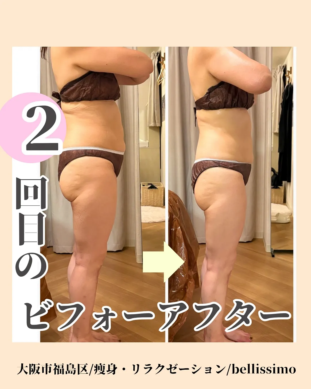 大人気！全身痩身のビフォーアフター✨