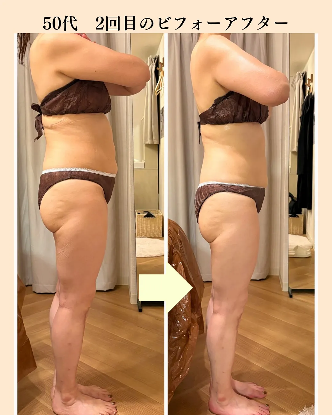 大人気！全身痩身のビフォーアフター✨