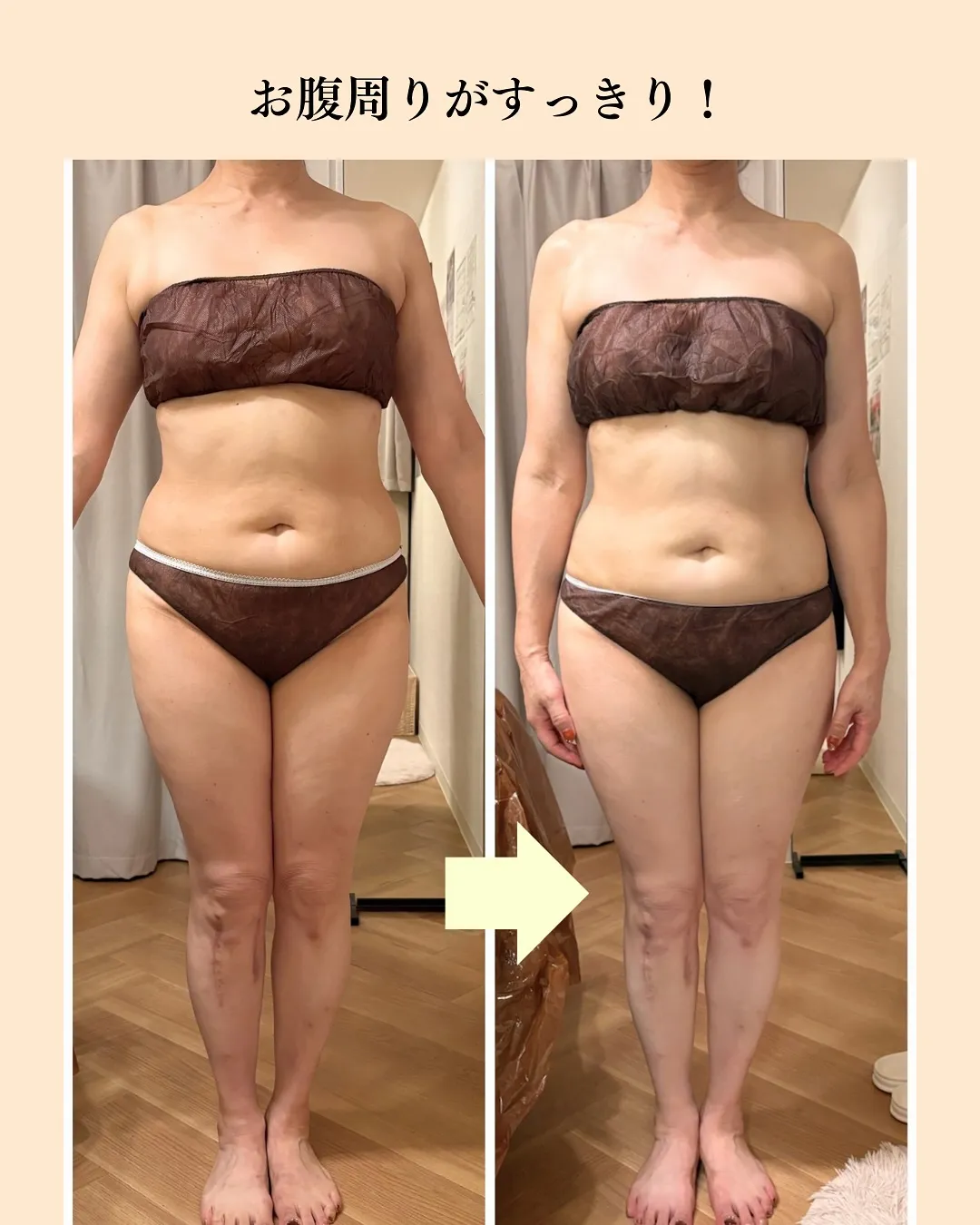 大人気！全身痩身のビフォーアフター✨
