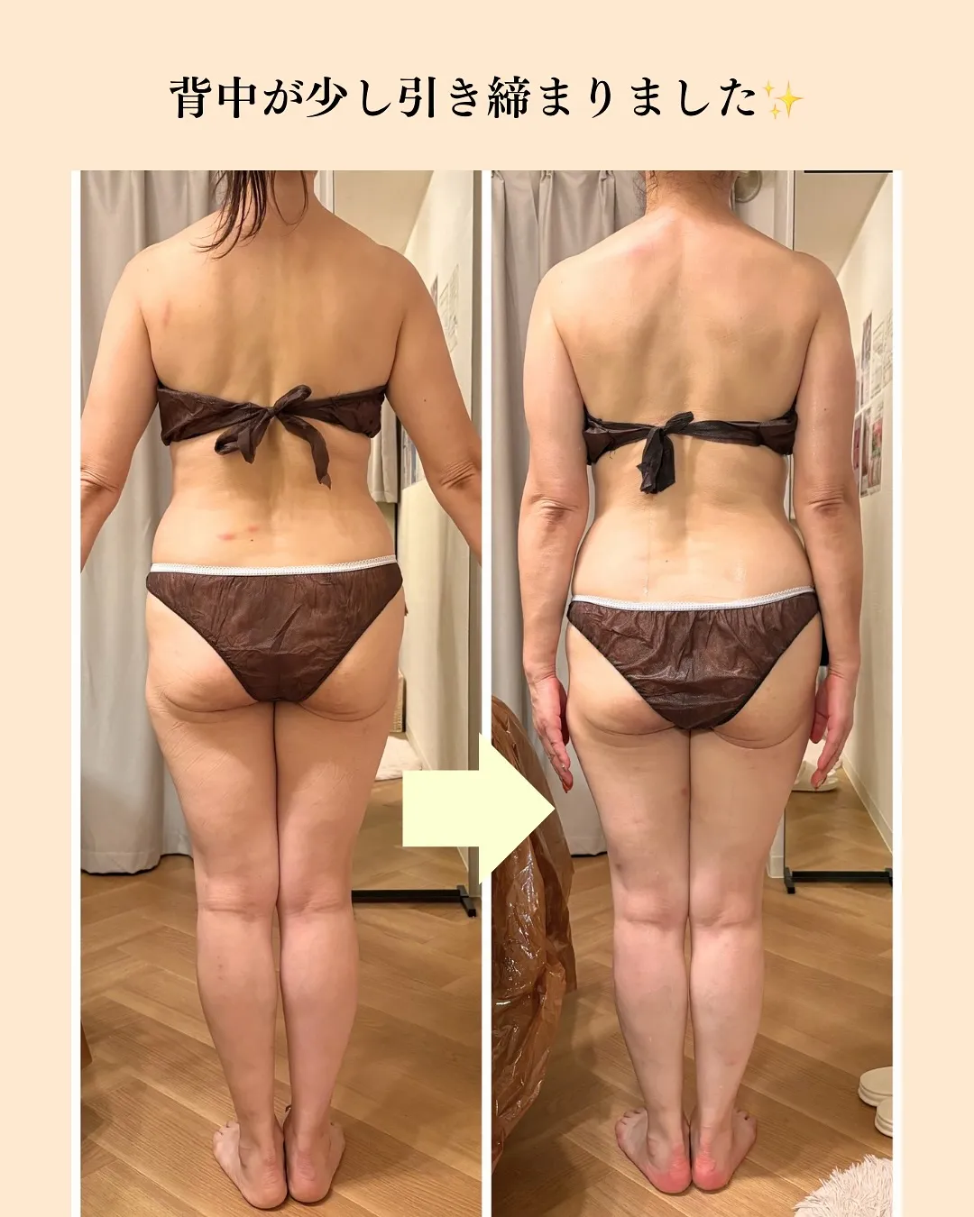 大人気！全身痩身のビフォーアフター✨